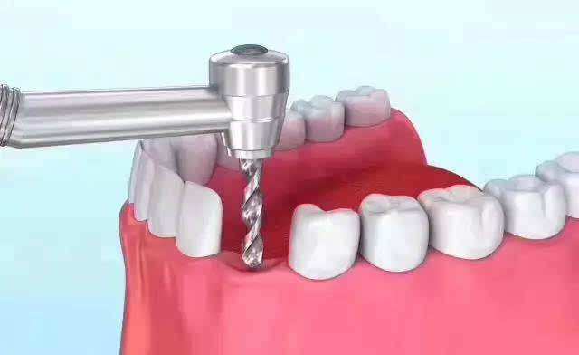 牙齿修复有哪些常见方法